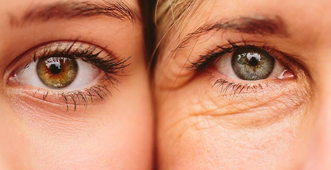 مختلف عمر کی دو خواتین میں آنکھوں کے گرد جلد کی عمر بڑھنے کی بیرونی علامات