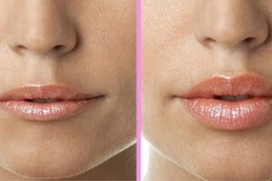 ہونٹ کی بحالی کے طریقہ کار سے پہلے اور بعد میں